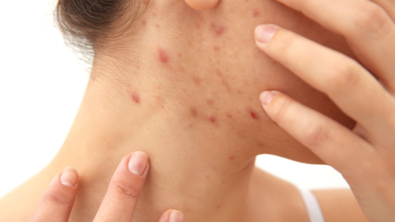 Comment l'acné et le sommeil sont-ils liés ?