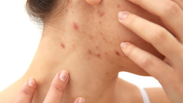 Tout savoir sur les liens entre le sommeil et l'acné